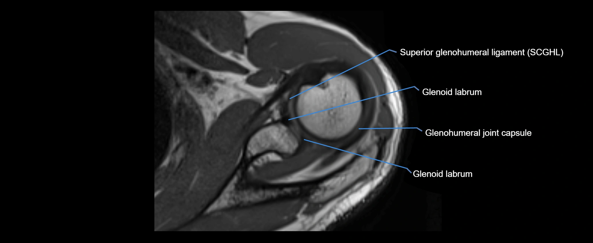 shoulder ligaments axial 3d 3t mri image-img-00005-00049.webp